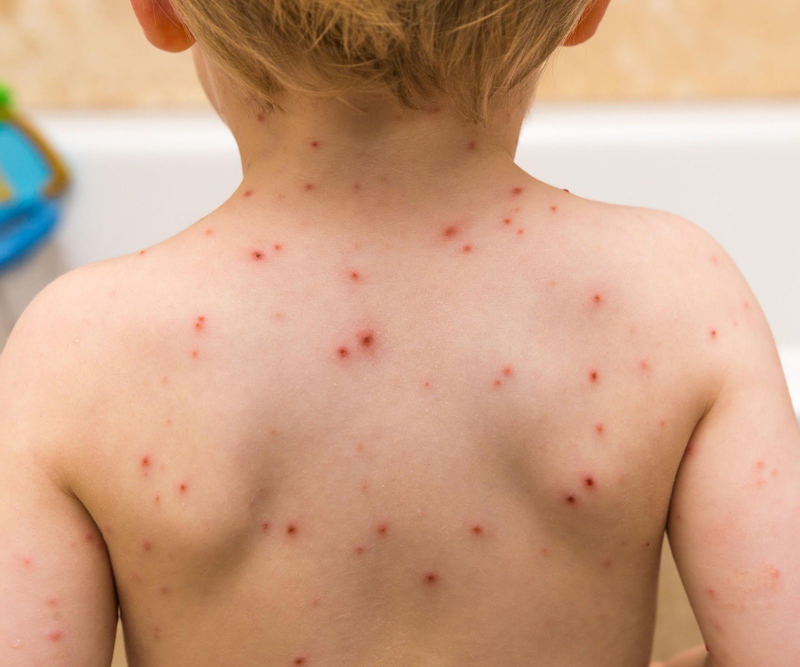 Things to know about chickenpox vaccine