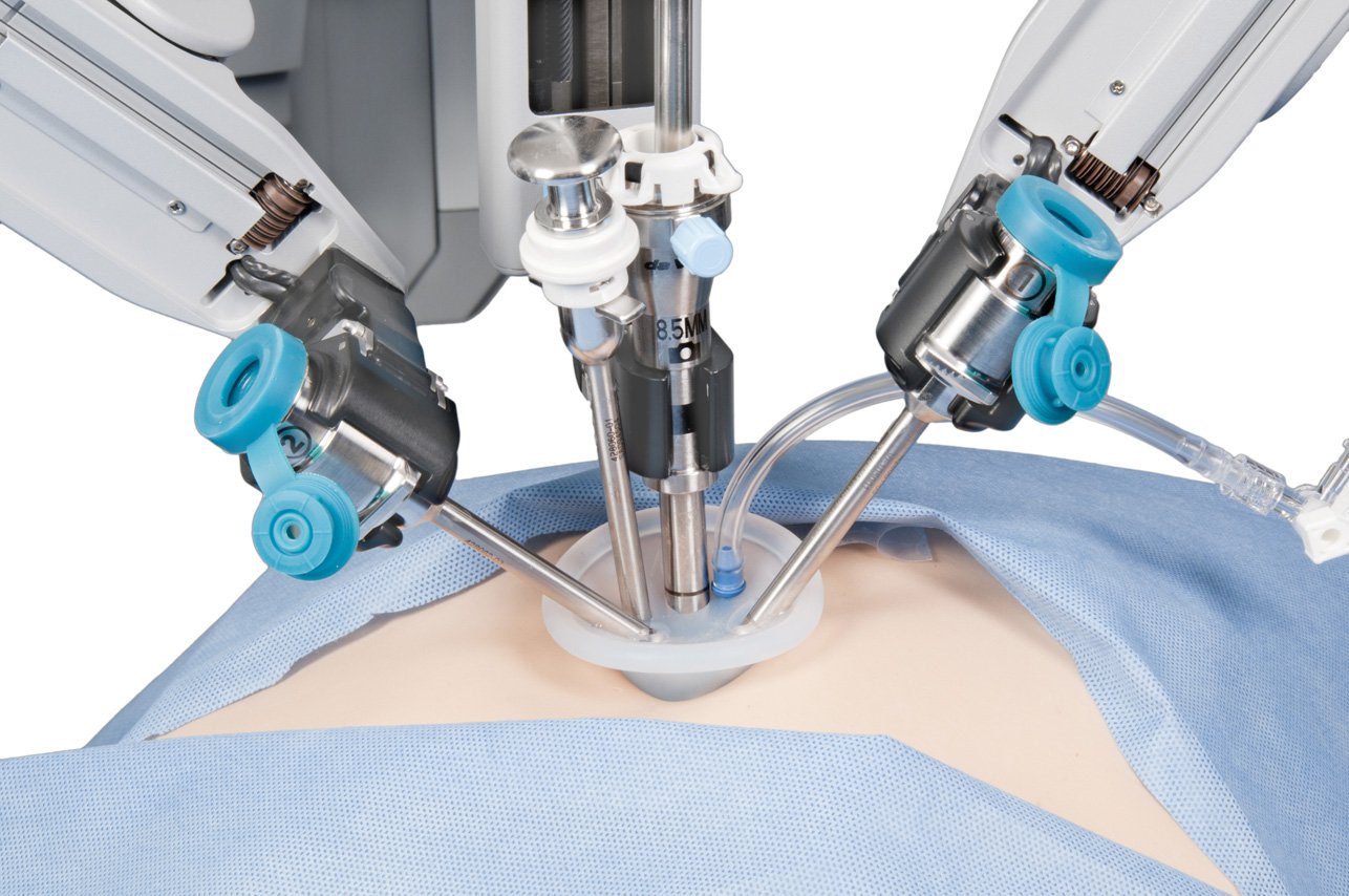 Robotic Gallstone Surgery