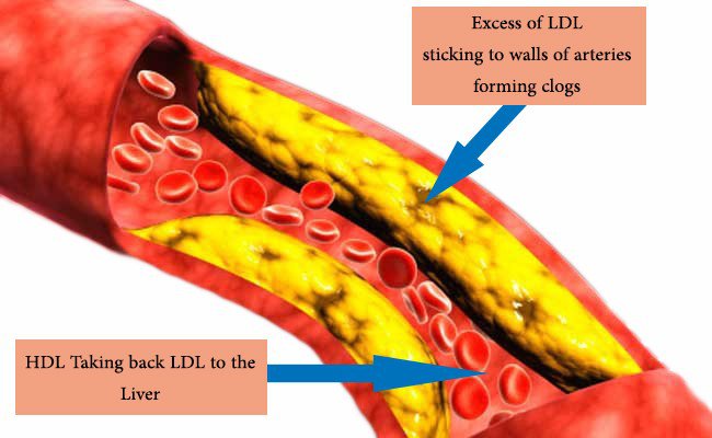 LDL cholesterol causes atherosclerosis