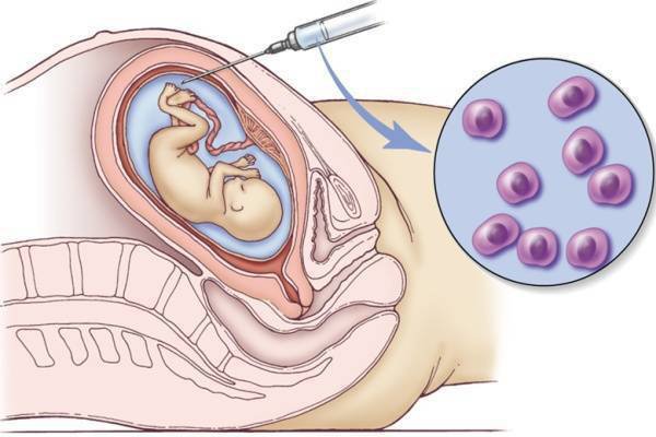 Amniotic puncture