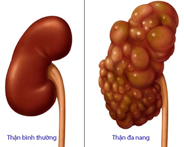 Are polycystic kidneys heredity