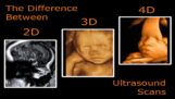 4D Ultrasound And What Is The Difference Between 3D – 4D?