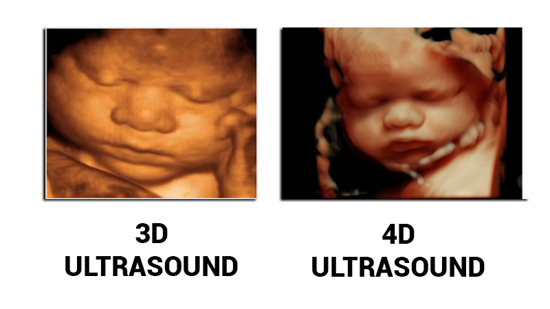 What is the difference between 3d and 4d ultrasound?